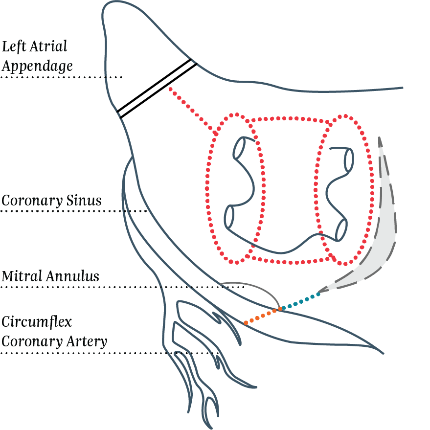 Left Atrial Lesion Set (LAL) and LAAM