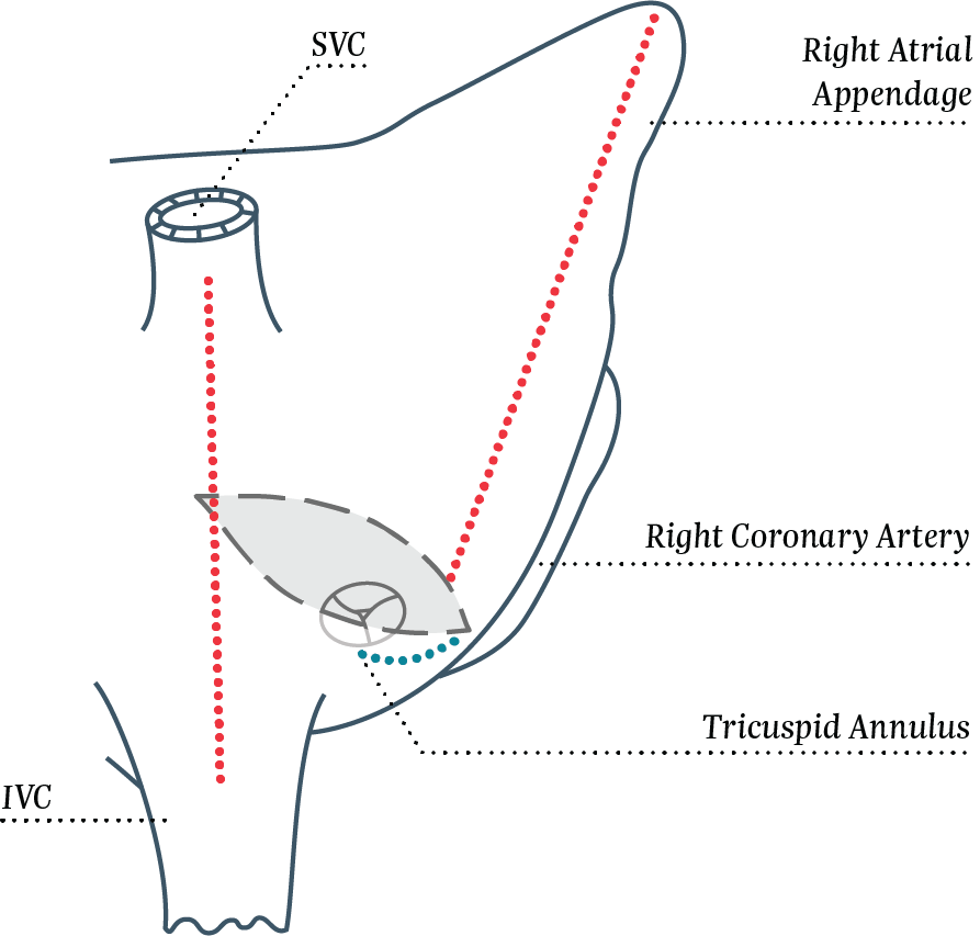 Right Atrial Lesion Set (RAL) and LAAM